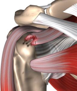 Rotator Cuff Repair Surgery Boise